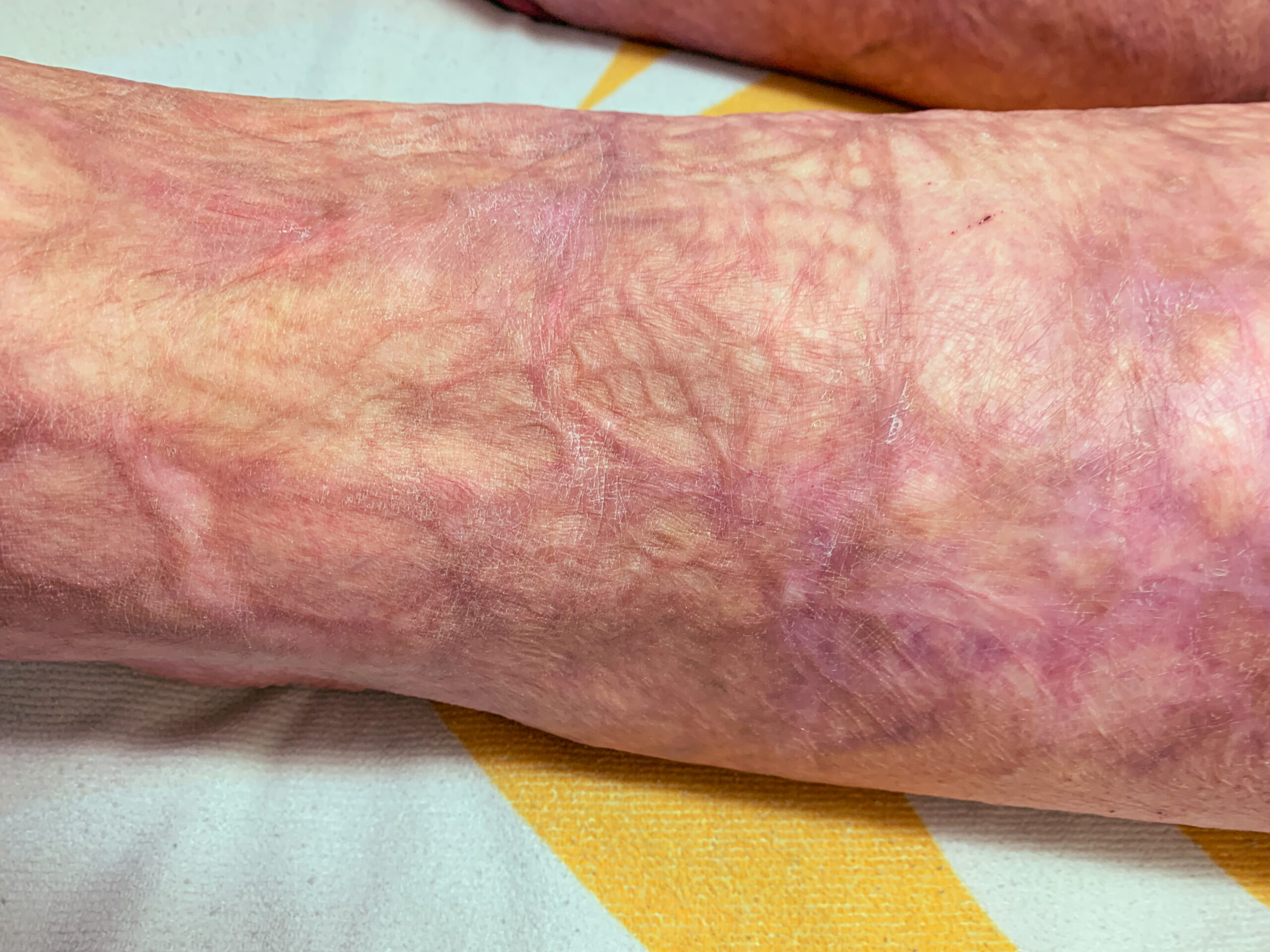 Photo of a burn scar on the leg