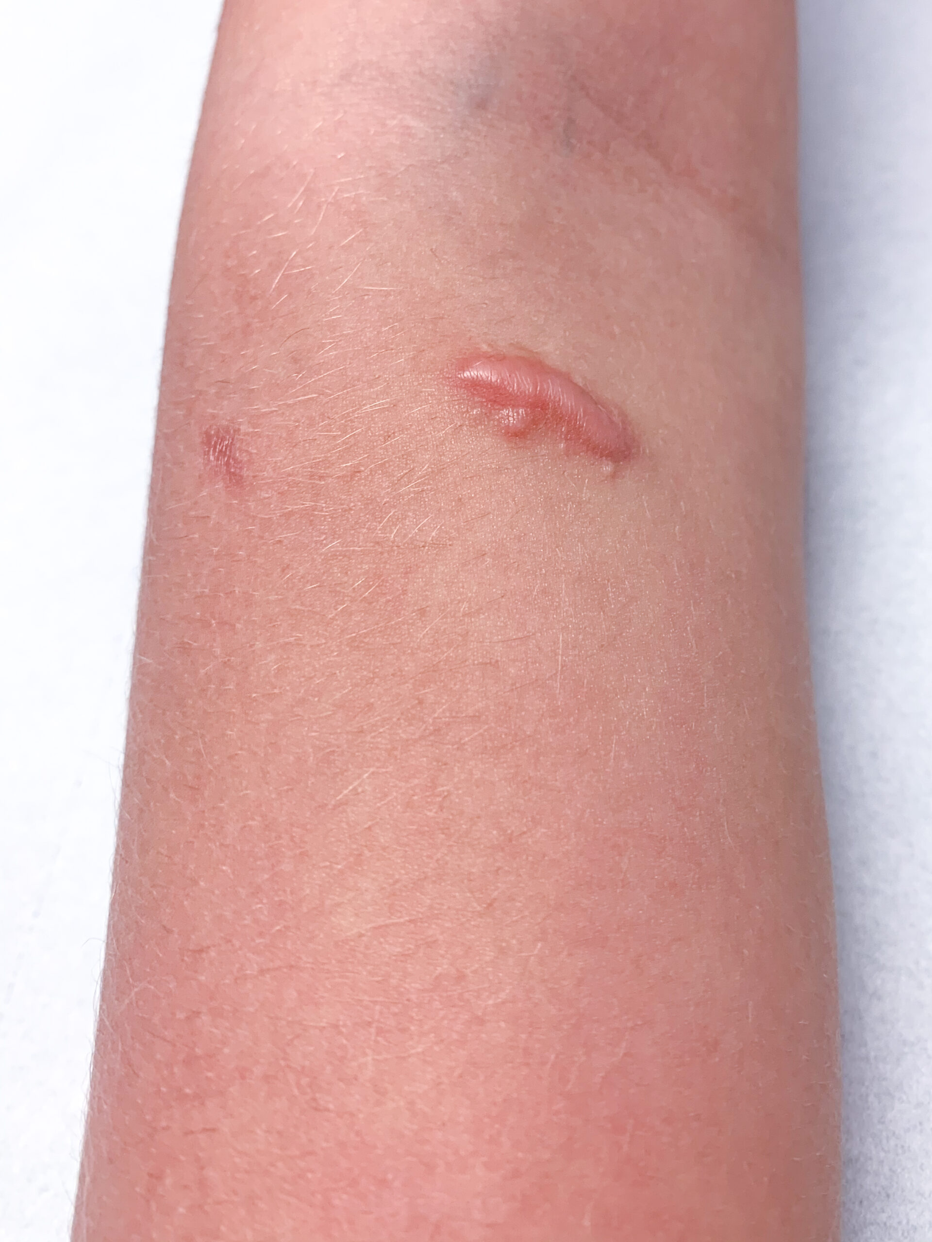 Photo of a small keloid on the arm