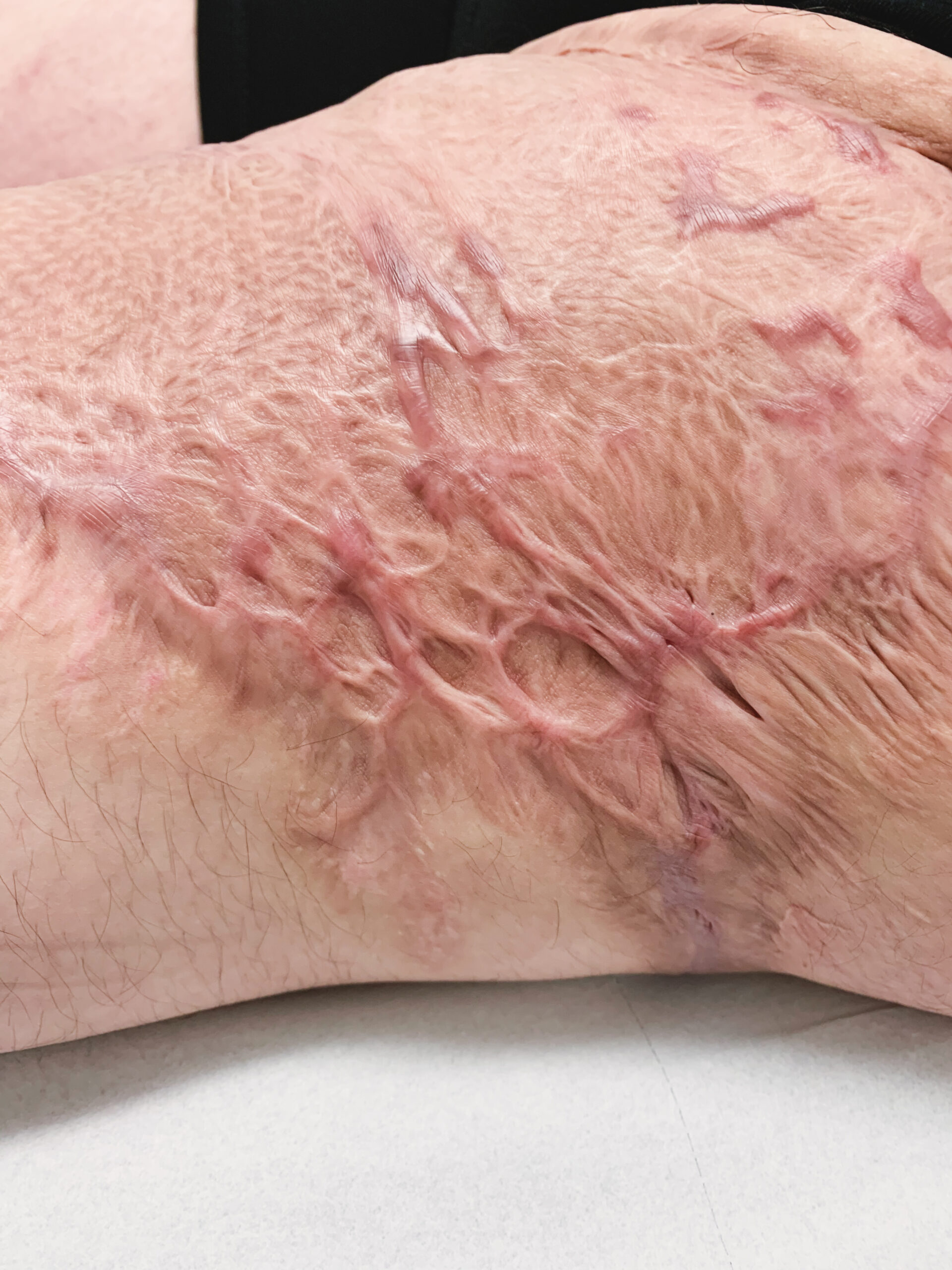 A scar on the leg with texture