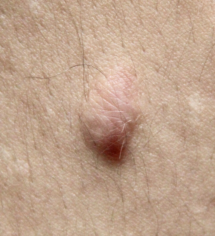 A scar with thickness