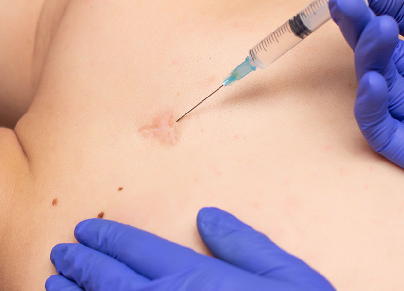 Photo of injection of corticosteroids into scar