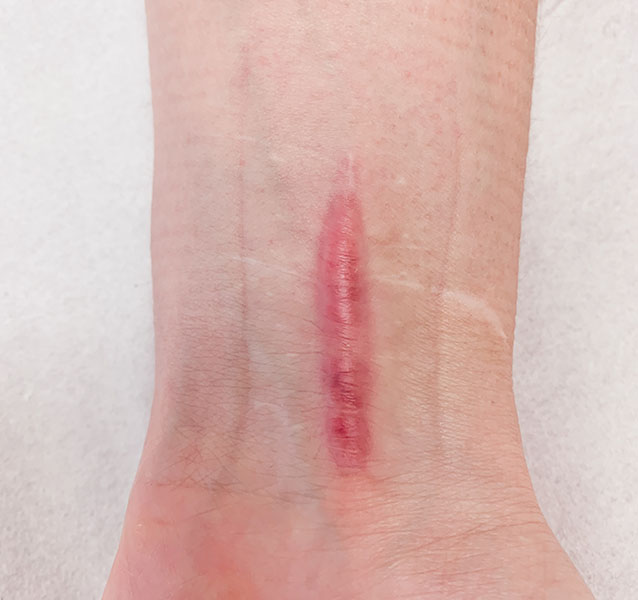 Photo of a linear scar on the wrist
