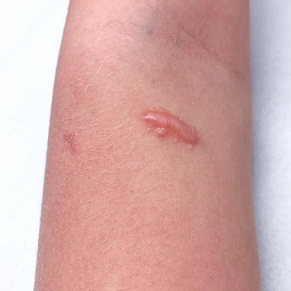 Photo of a small keloid on the arm