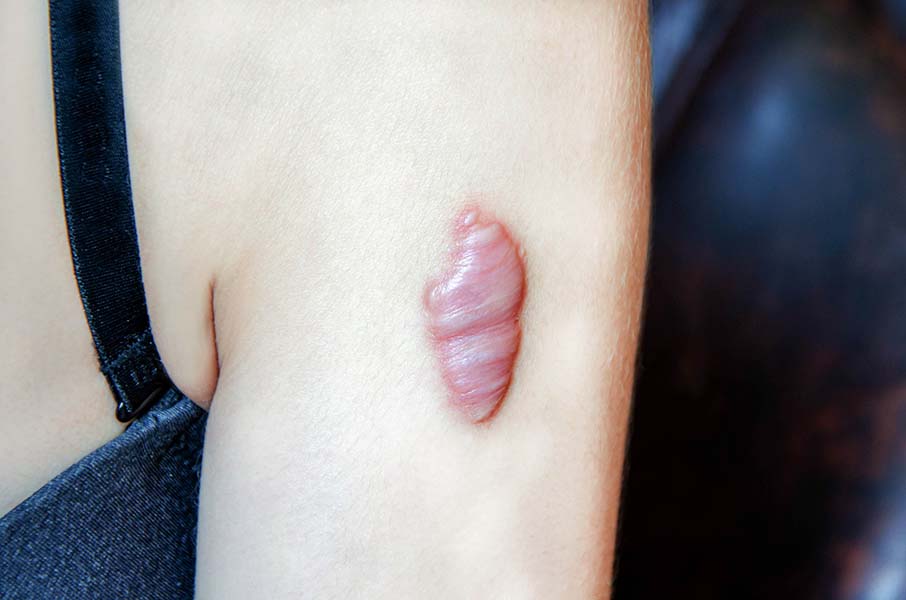 Photo of a vertical keloid on the arm