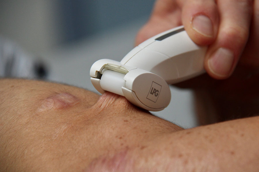 Photo of a vacuum massage device used on a scar
