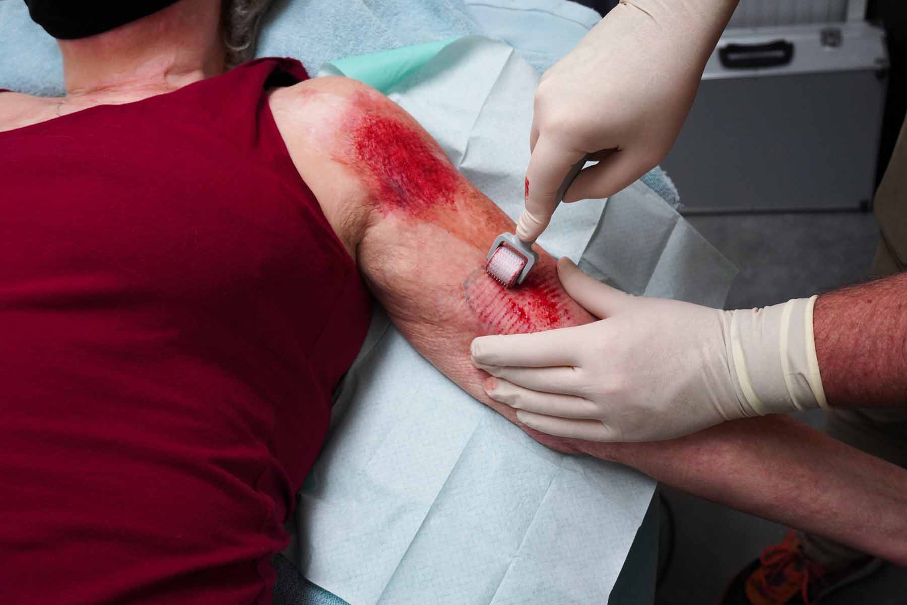 Foto van micro-needling met een dermaroller op een litteken op de bovenarm