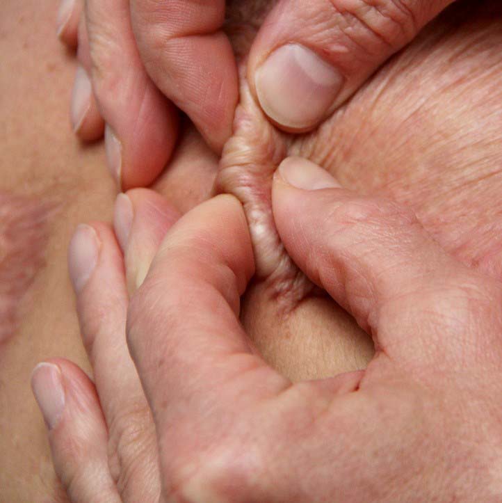 Foto van twee handen die een litteken masseren